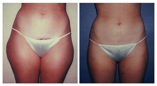 Upper and Lower Abdomen and Flank Liposuction, Inner and Outer Thigh  Liposuction with Fat Transfer to Buttocks - Terrell Clinic